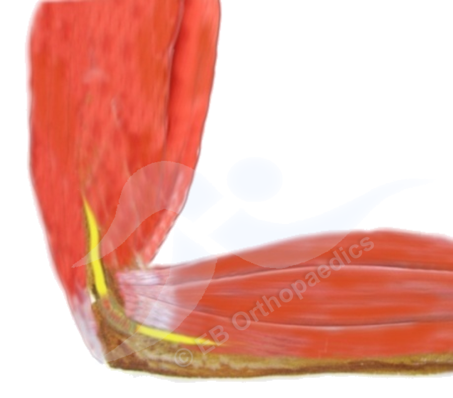 Cubital tunnel syndrome